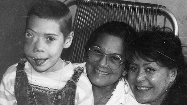 Una de las víctimas de Chernóbil tras sufrir una operación donde se le extirpó un tumor en el rostro