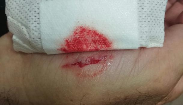 Imagen de la herida tras el mordisco que ha sufrido este funcionario. SUCESOS
