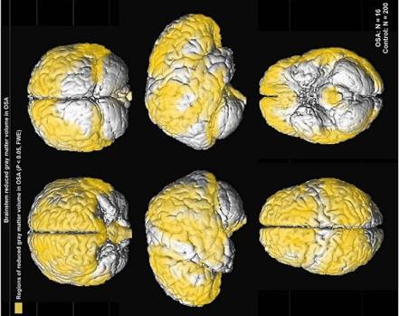 Reducción de la sustancia gris en el tronco del encéfalo por la apnea del sueño