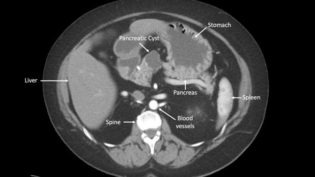 Imagen de un tumor en el páncreas