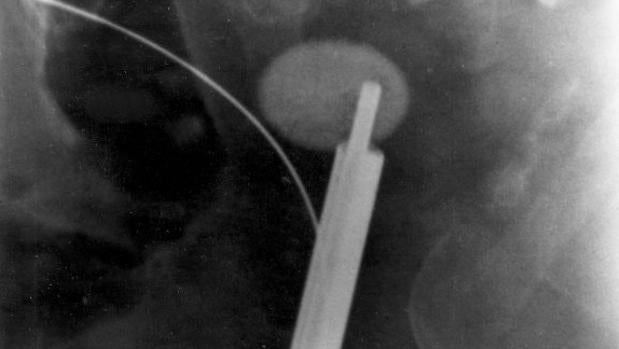 Imagen tomada mediante rayos X de un cálculo renal causante de cólicos nefríticos