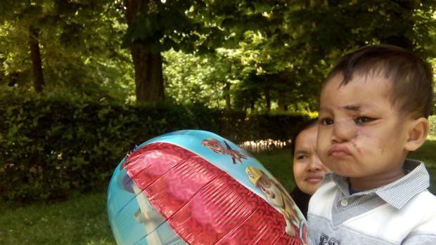 El pequeño Kanbonna después de la operación